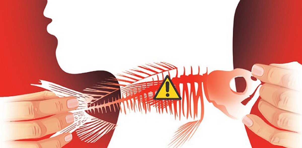 Bị hóc xương cá &#8211; Xử lý sao cho đúng cách?