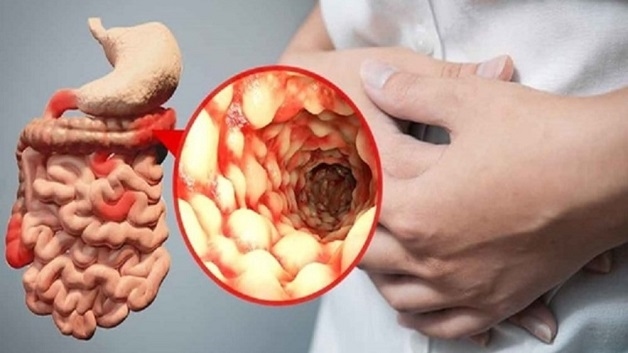Viêm ruột là bệnh lý phổ biến ở hệ tiêu hóa