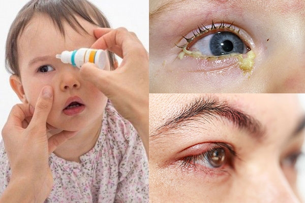Cách chữa viêm kết mạc