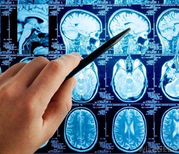 Đột quỵ nhồi máu não cấp trên phim chụp mri
