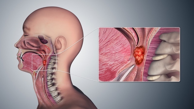 Biểu hiện ung thư vòm họng phổ biến cần biết