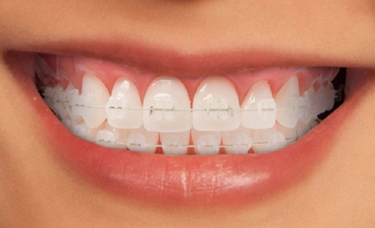Niềng răng mắc cài sứ và những điều cần biết