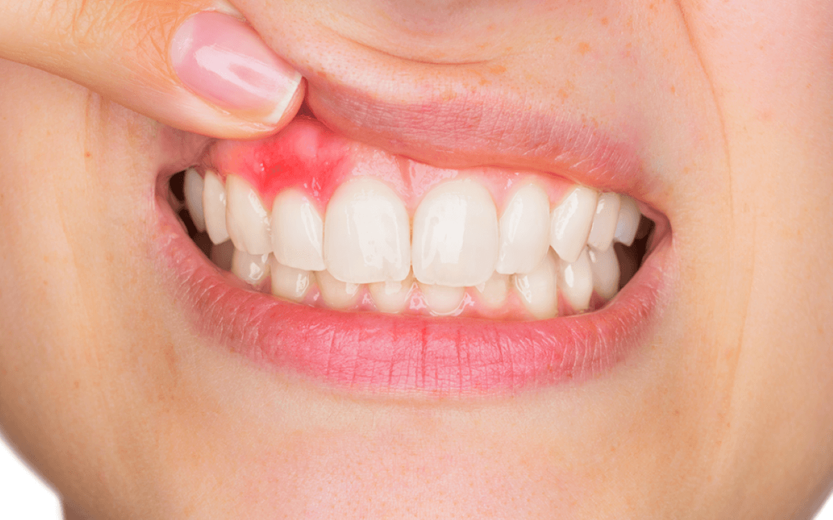 Cách khắc phục tình trạng rách lợi chân răng