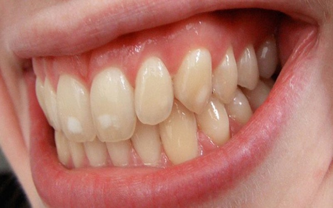 Tình trạng răng nhiễm Tetracycline, đâu là nguyên nhân?
