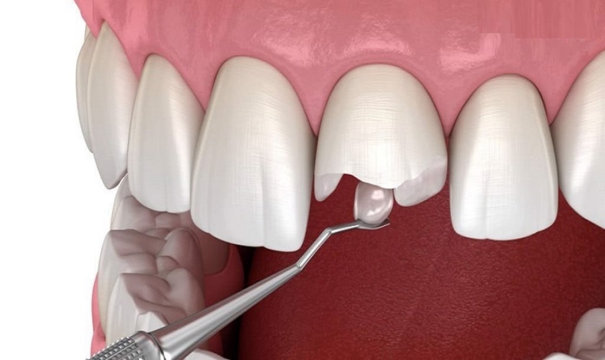 Sâu răng cửa có thể hàn trám được không?