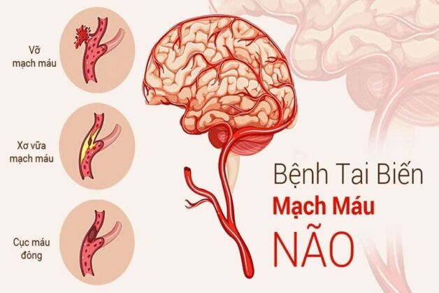Tai biến mạch máu não là gì, có biểu hiện như thế nào 