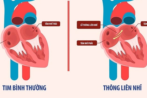 6-10% bệnh nhân thông liên nhĩ là do bẩm sinh