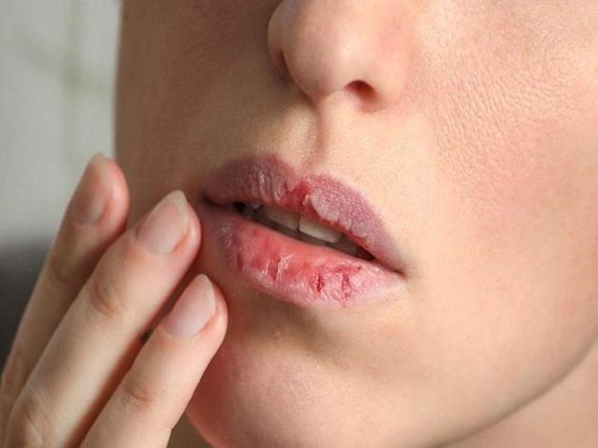 Tình trạng khô miệng có phải vấn đề đáng ngại?