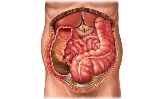Đau ruột thừa cấp có thể gây viêm phúc mạc