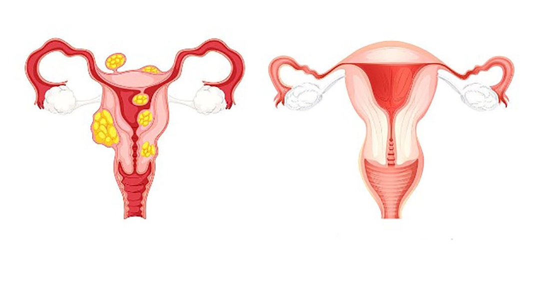 Những cách điều trị u xơ tử cung không cần phẫu thuật