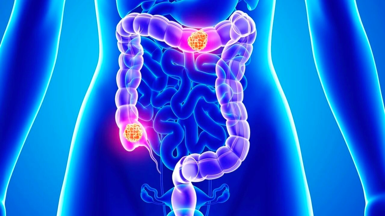 Những hiểu biết về ung thư đại tràng di căn hạch