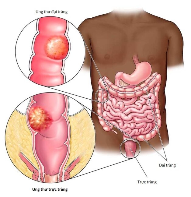 Tất cả thông tin về ung thư trực tràng giai đoạn di căn