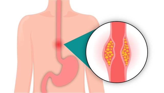 Tìm hiểu điều trị ung thư thực quản bằng xạ trị