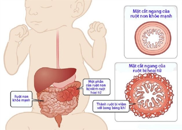 Thận trọng với viêm ruột hoại tử ở trẻ sơ sinh