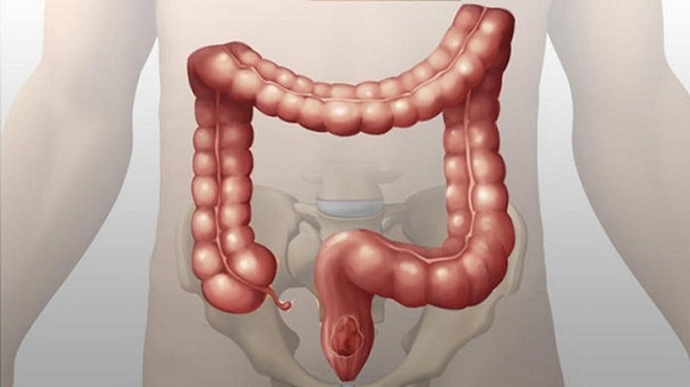 Bệnh đau ruột già là bệnh lý phổ biến ở hệ tiêu hóa