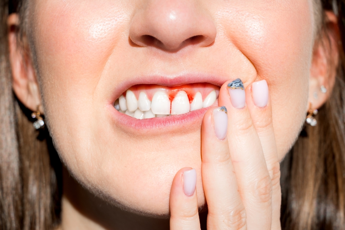 Cách khắc phục tình trạng bọc răng sứ bị chảy máu