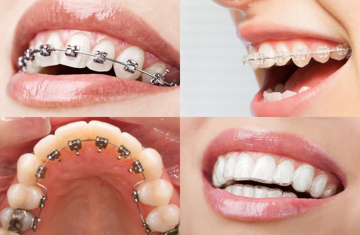 Các loại niềng răng phổ biến hiện nay