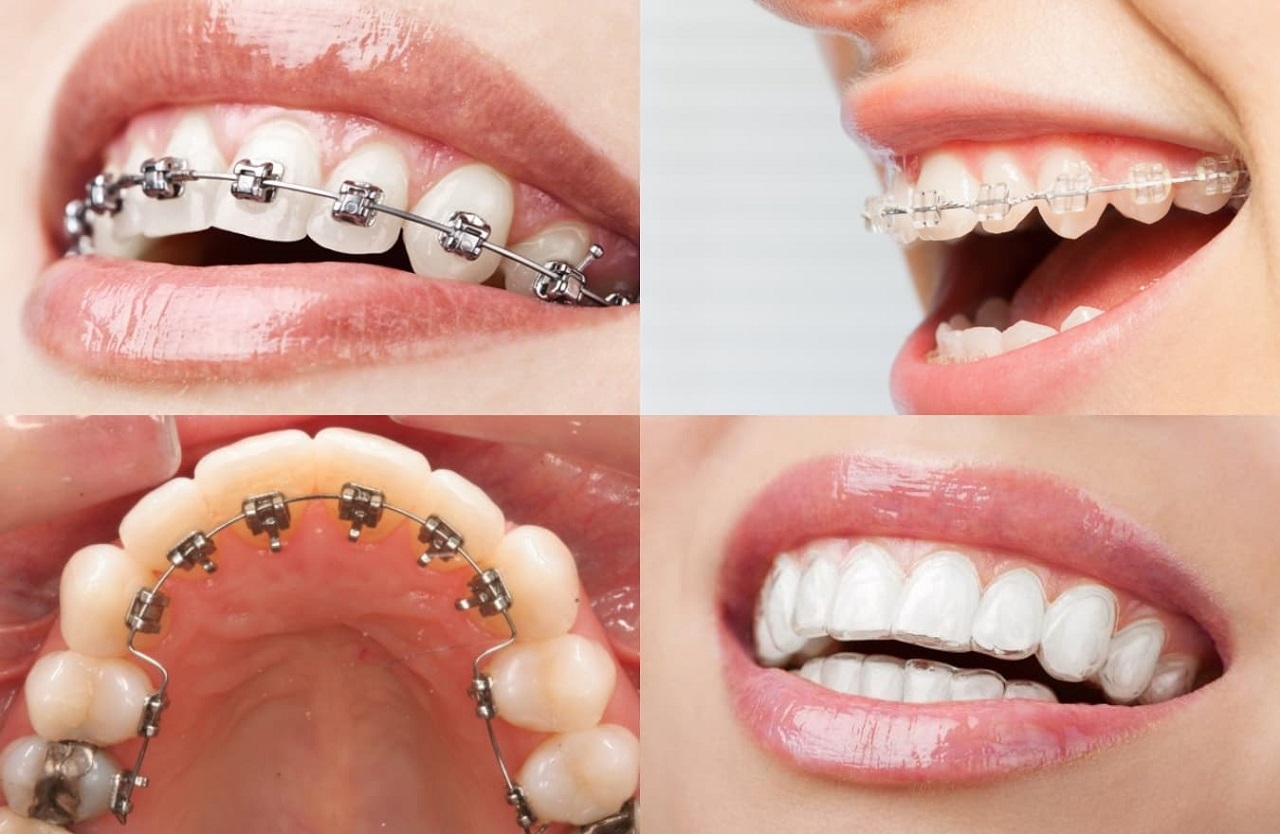 Các loại niềng răng phổ biến hiện nay