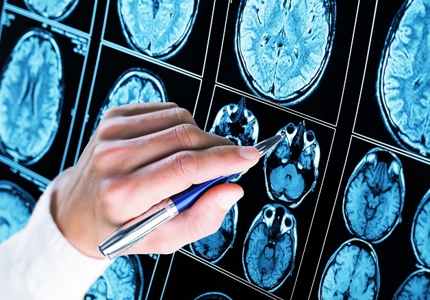 muốn tìm cách chữa bệnh động kinh cần tìm đúng nguyên nhân 