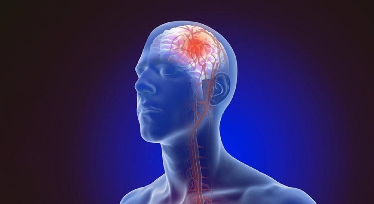 Hiểu đúng về điều trị tai biến mạch máu não