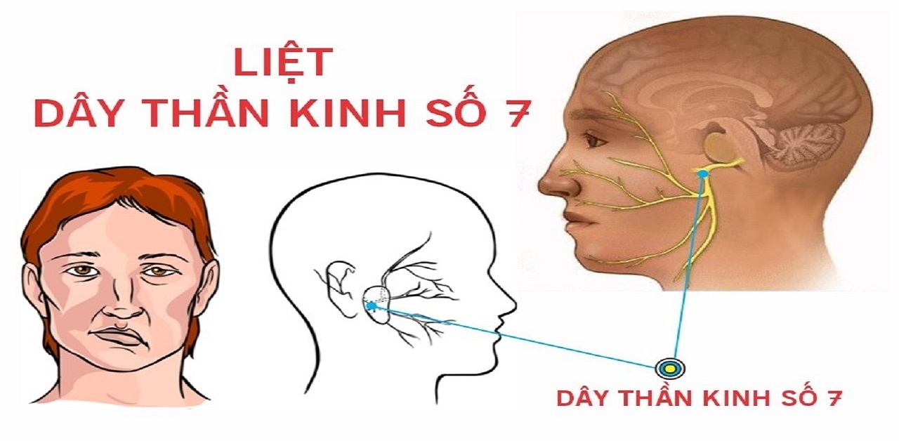 Liệt dây 7 trung ương để lại di chứng nặng nề