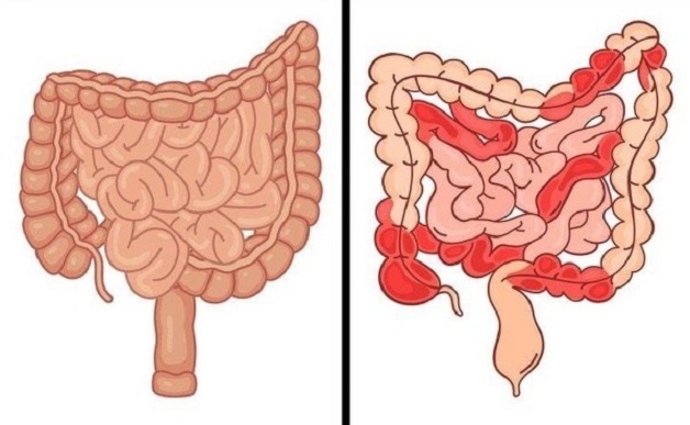 Loét ruột non là bệnh lý khá phổ biến ở hệ tiêu hóa