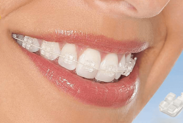 Niềng răng mắc cài sứ dây trong