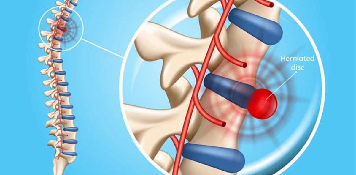 Nhận biết thoát vị đĩa đệm L4 L5 và cách điều trị