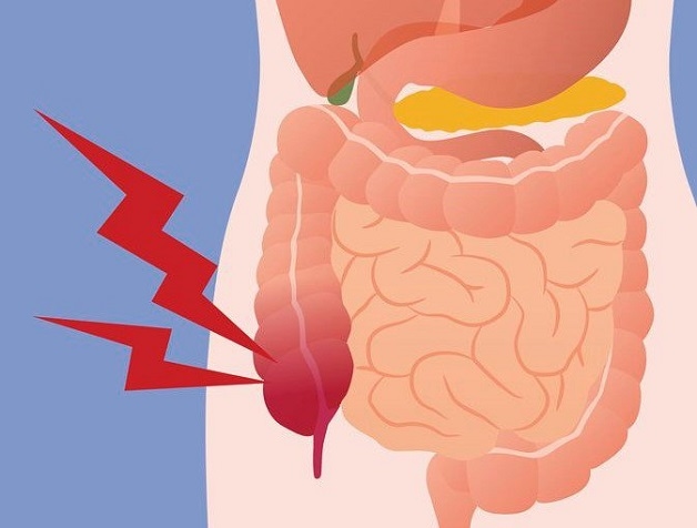 Viêm ruột gây ra triệu chứng của viêm ruột thừa