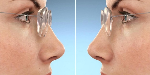 tròng kính cận mỏng cho người cận nặng