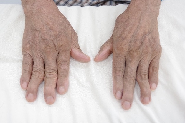 Triệu chứng của bệnh viêm khớp dạng thấp gồm có đau, sưng và cứng khớp