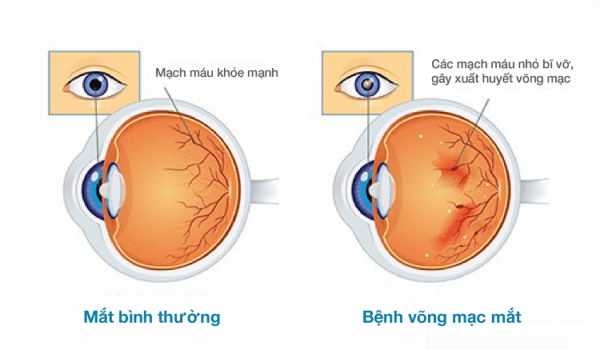 Tìm hiểu võng mạc tiểu đường là gì?