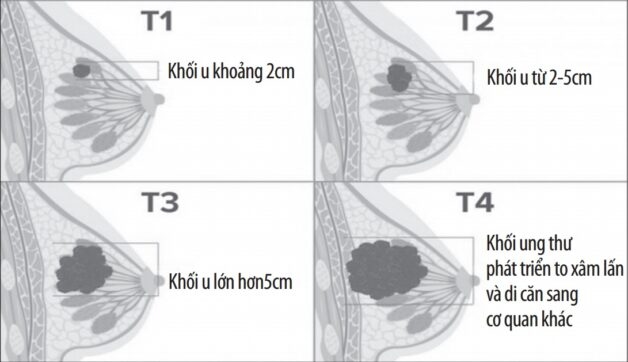 Khối u vú khi còn lành tính và khi phát tiển sang ung thư vú