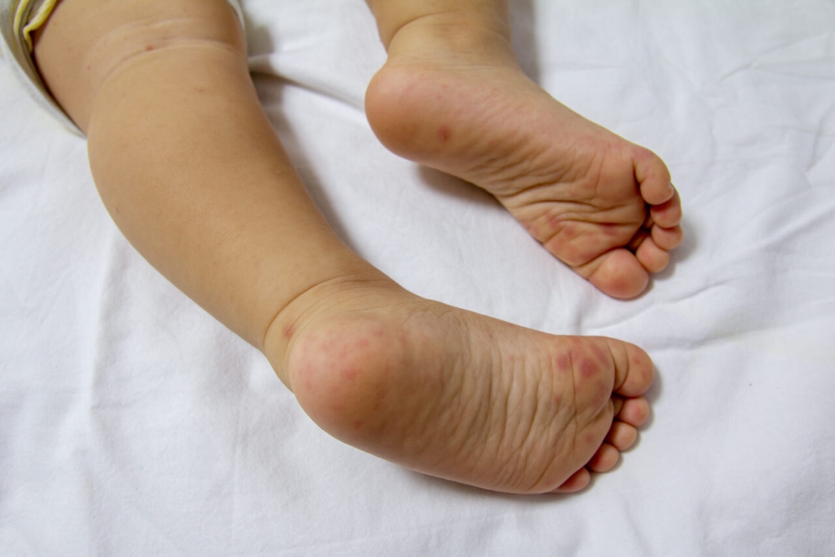 4 lưu ý quan trọng về bệnh tay chân miệng trẻ em