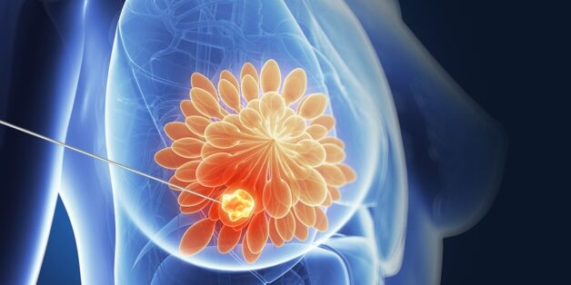 Hầu hết nhân tuyến vú BIRADS 3 là lành tính