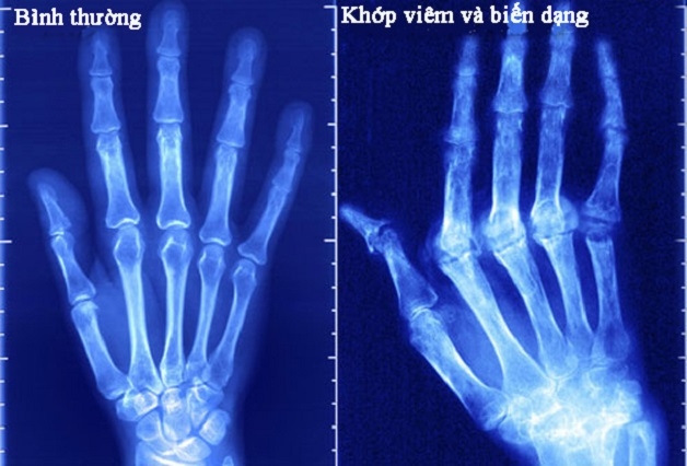 viêm khớp dạng thấp bệnh học gây biến dạng khớp trên phim chụp X Quang