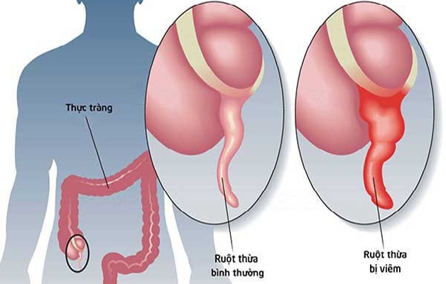 Vị trí ruột thừa trong ống tiêu hóa.