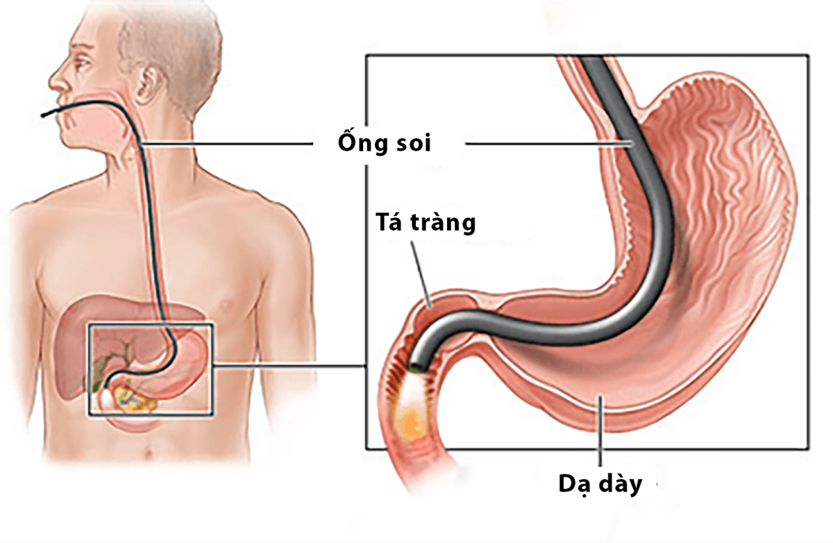 Nội soi viêm dạ dày &#8211; Phương pháp và quy trình thực hiện