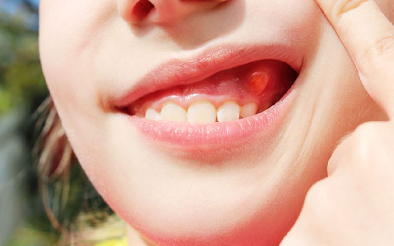 Phương pháp điều trị sưng rộp nướu răng