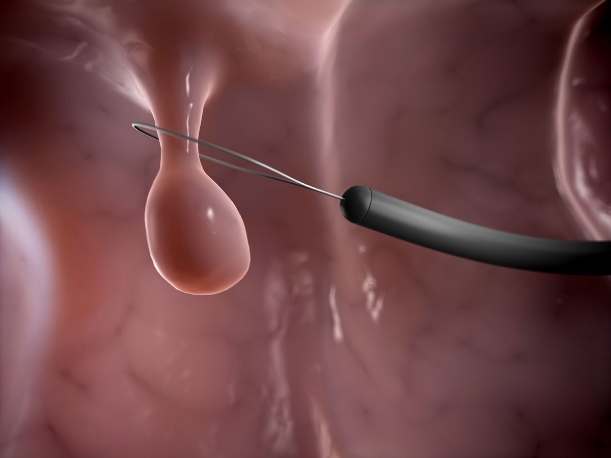 Polyp đại tràng &#8211; Những điều có thể bạn chưa biết 