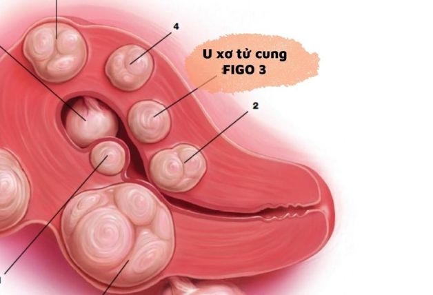 Nên ưu tiên dùng thuốc làm teo u với loại u xơ FIGO 3