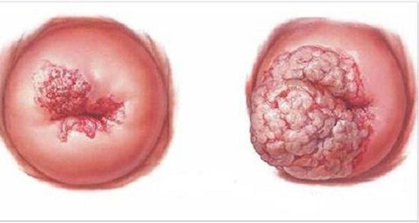 Khái niệm ung thư cổ tử cung ở giai đoạn cuối