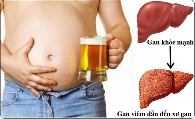Bệnh viêm gan do rượu tác động xấu tới sức khỏe.