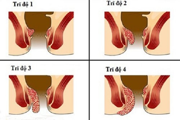 bệnh trĩ triệu chứng