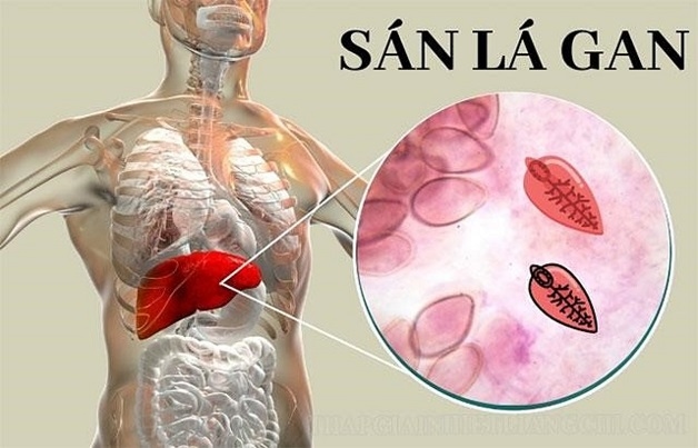 Đặc điểm gây bệnh của sán lá gan