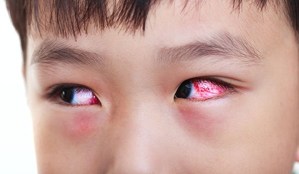 đau mắt đỏ có nên đi khám