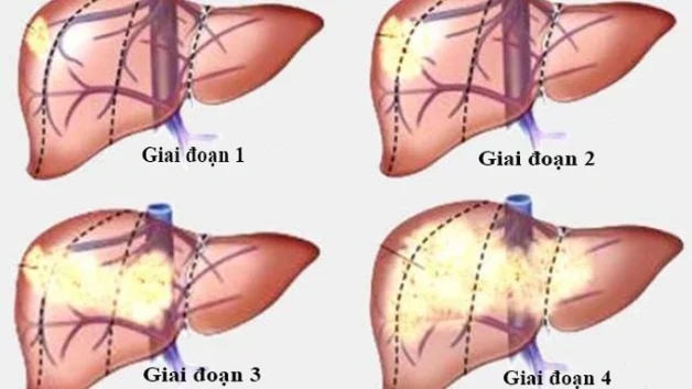 ung thư gan ở nam giới