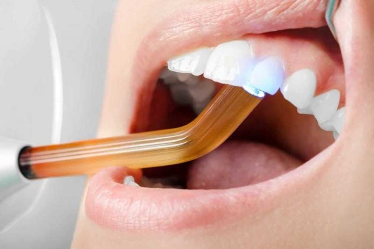 Những điểm nổi bật của hàn răng thẩm mỹ đóng kẽ thưa