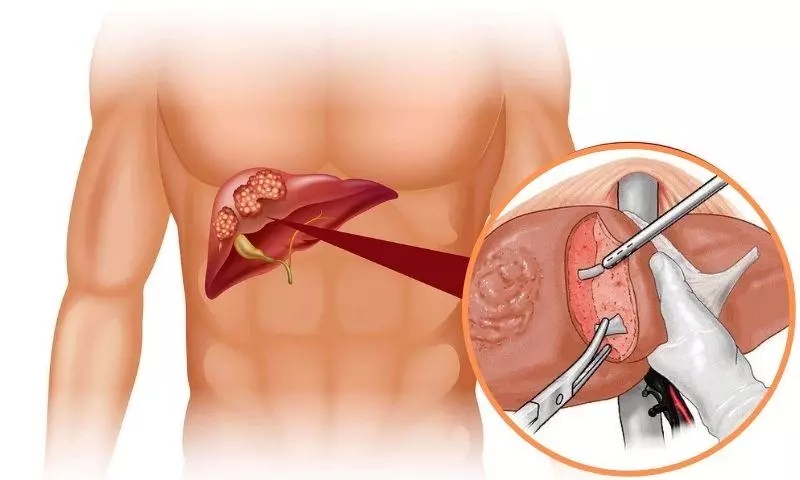 Ung thư gan điều trị phẫu thuật 