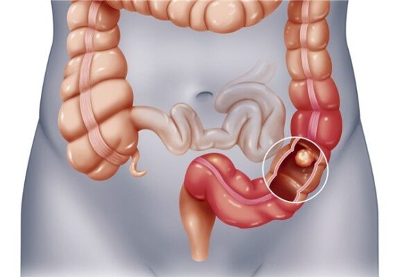 Polyp đại tràng trái là gì?